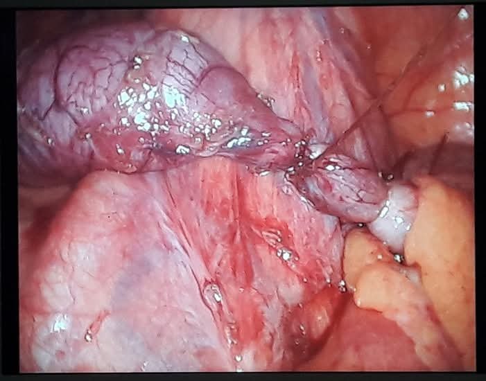 Laparoscopic view — appendiceal mucocele