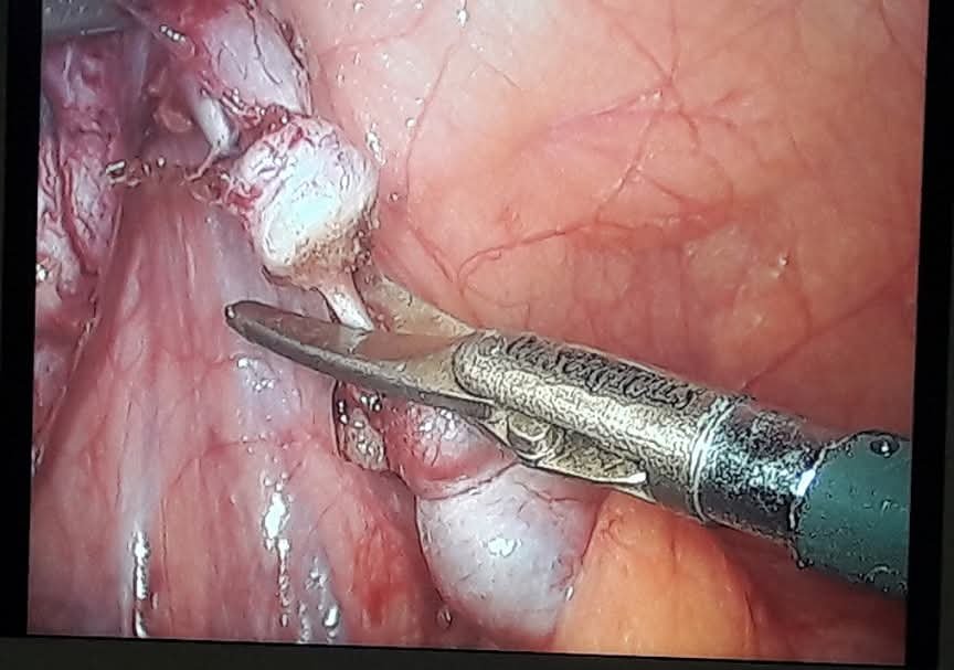 Laparoscopic dissection