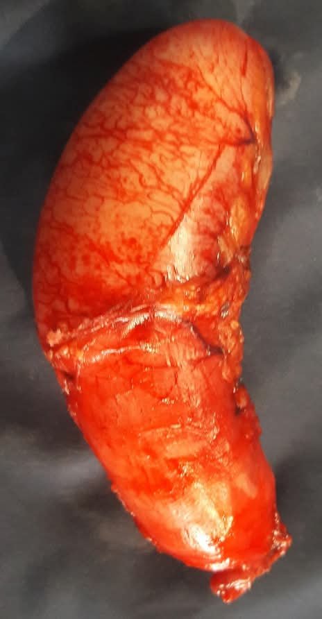 Laparoscopic Management of Appendiceal Mucocele