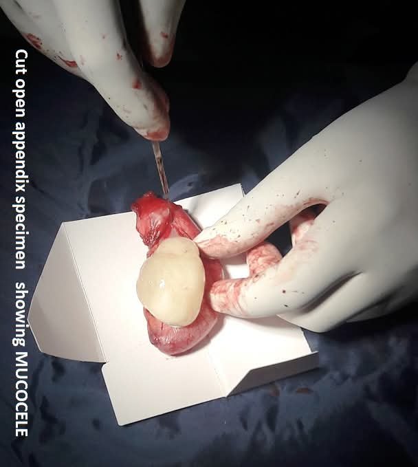 Cut open appendix specimen showing mucocele