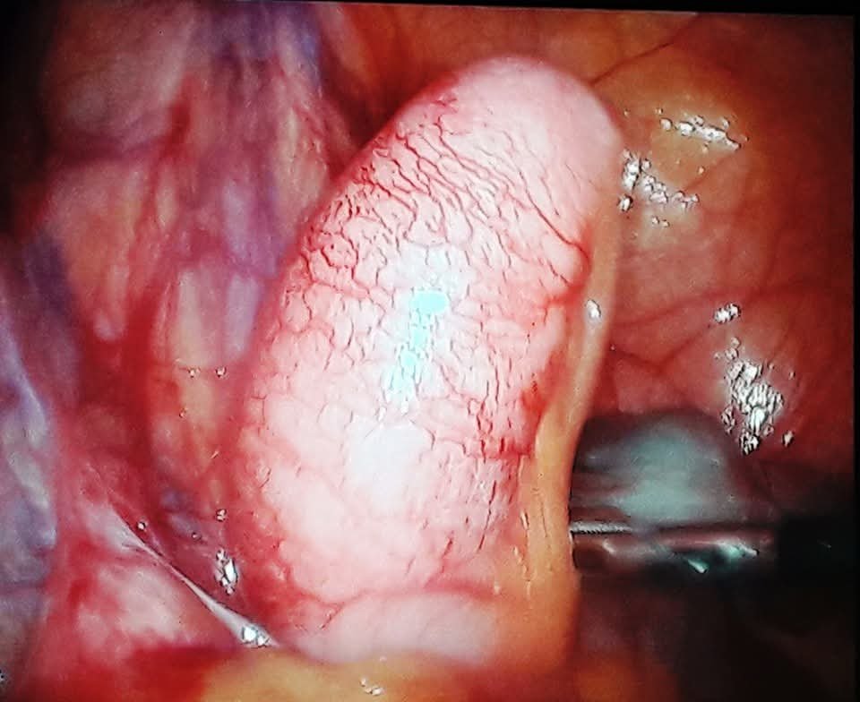 Distended appendix with mucocele