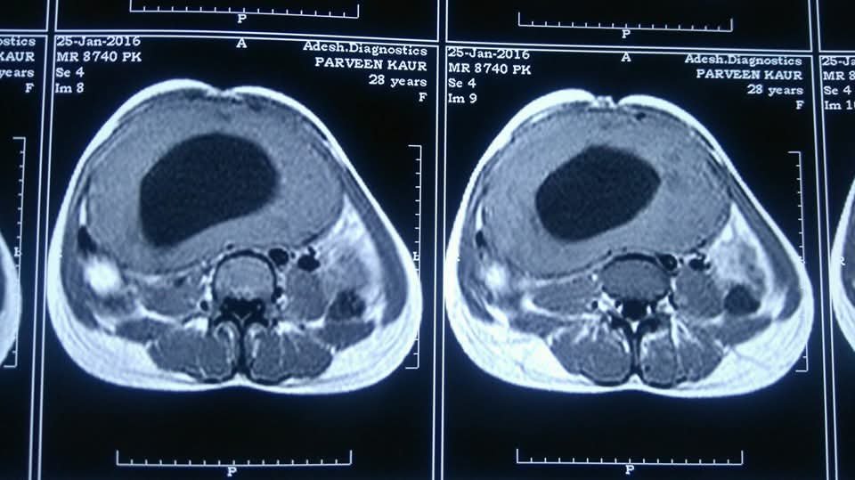 MRI showing a giant uterine pelvic mass