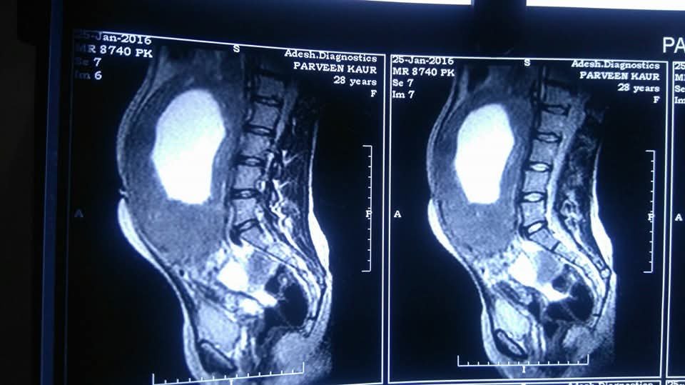 Sagittal MRI showing a giant uterine mass