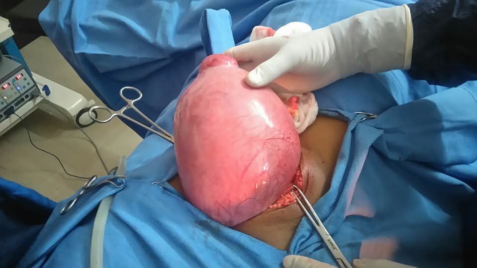 Giant 18 × 15 cm Uterine Pelvic Mass Successfully Managed with Radical Hysterectomy