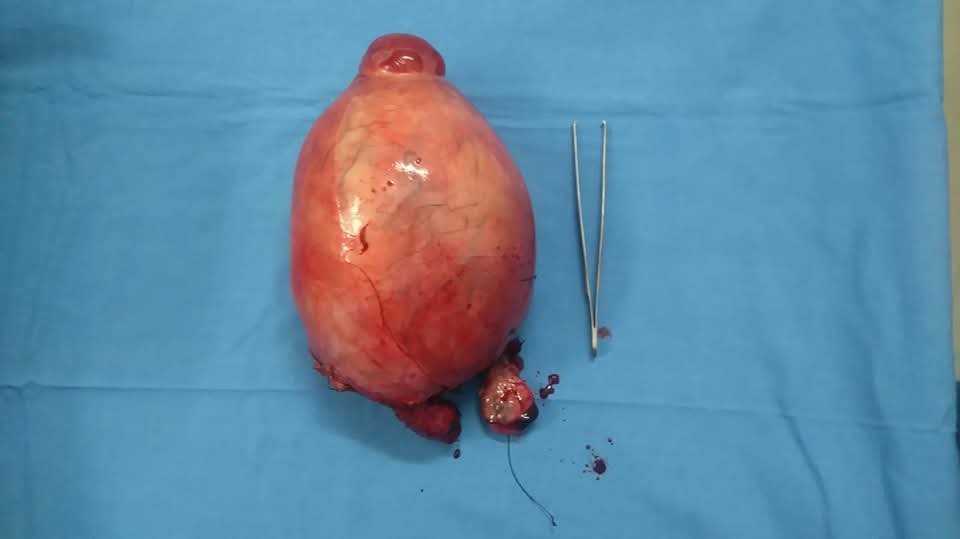 Excised giant uterine pelvic mass specimen