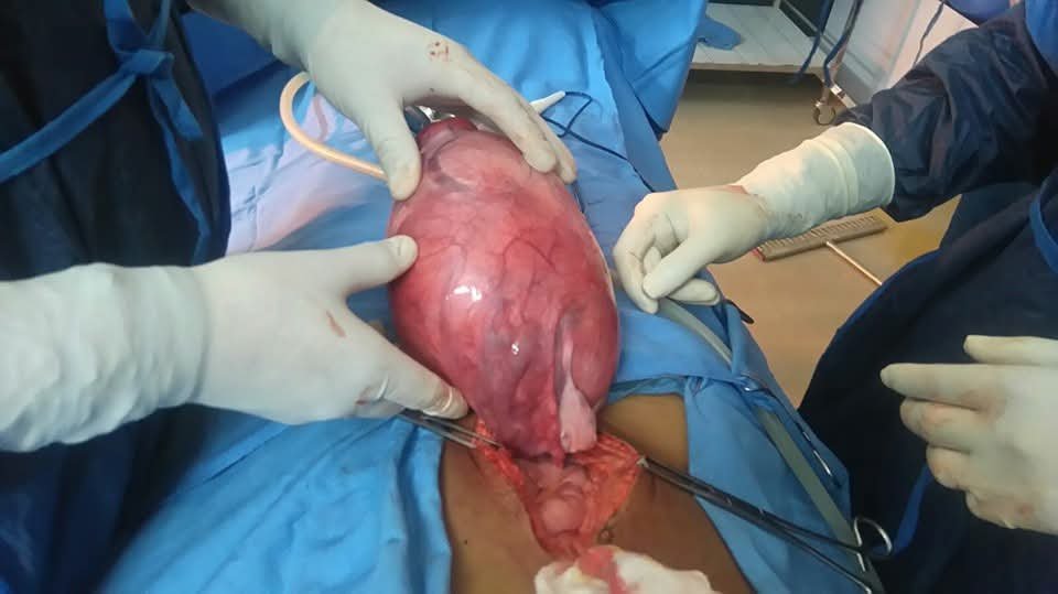 Surgical view of giant uterine mass excision