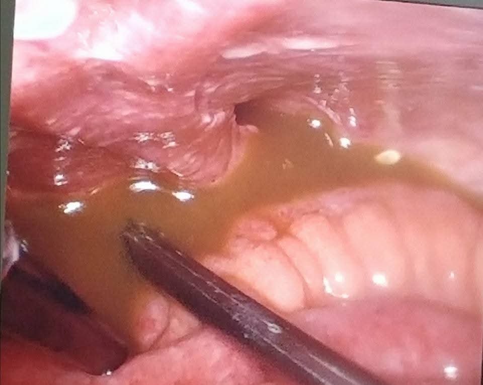 When Acute Appendicitis Turned Out to Be an Ileal Perforation