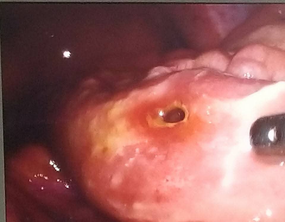 Intraoperative view during laparoscopic treatment of ileal perforation