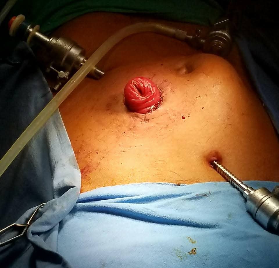 Laparoscopic loop ileostomy fashioned for ileal perforation