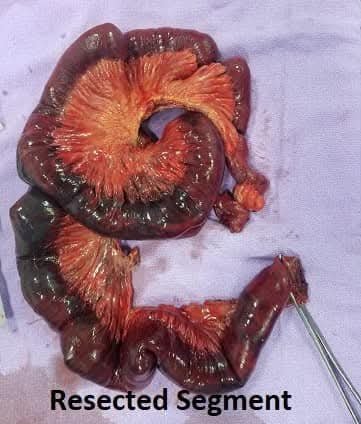 Massive Small Bowel Gangrene Successfully Treated with Emergency Surgery