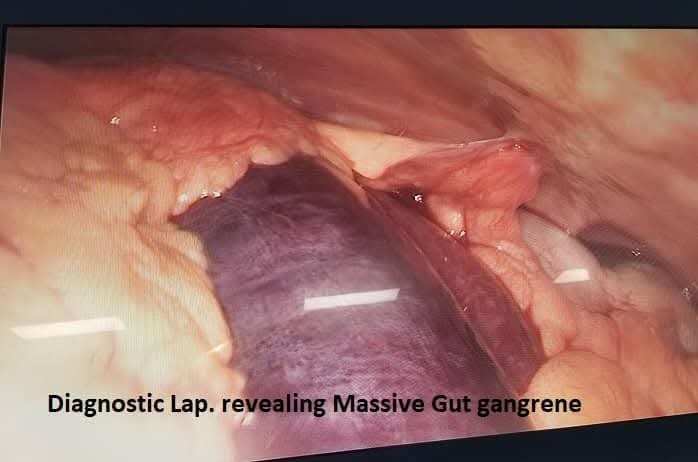 Small bowel resection specimen after emergency surgery