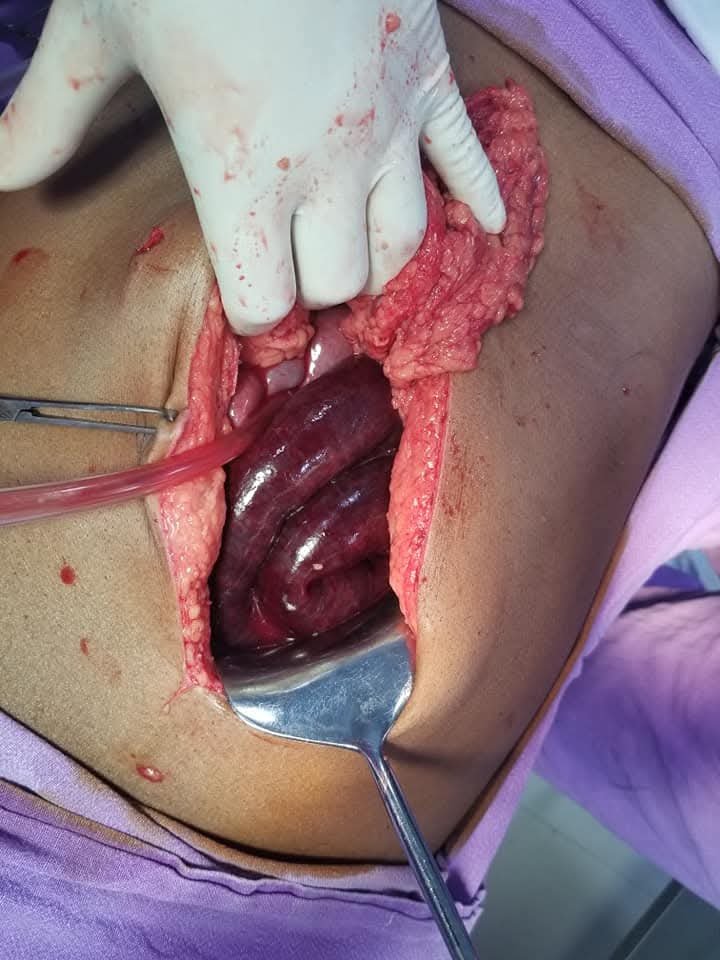 Gangrenous small bowel during exploratory laparotomy