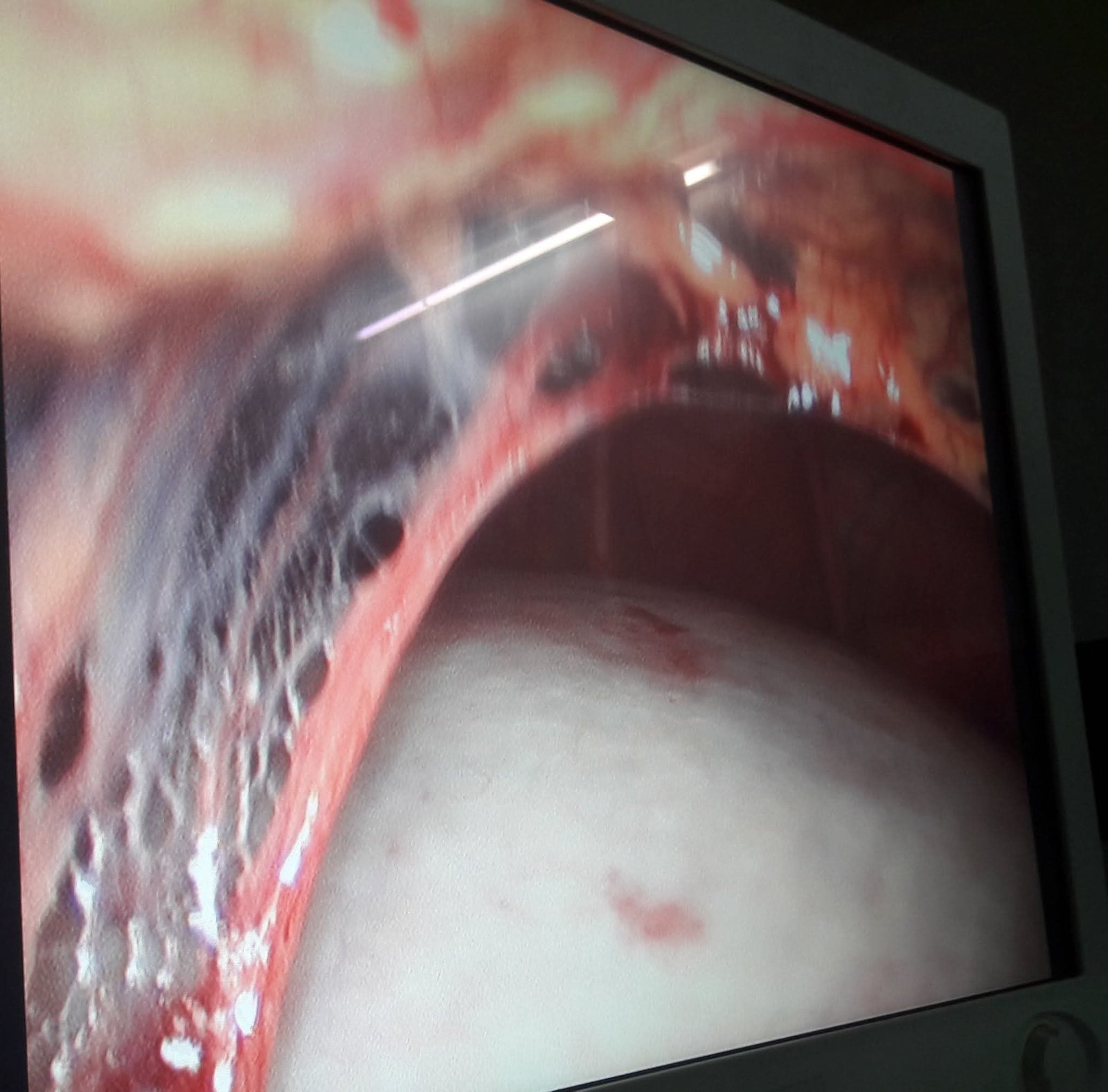 Laparoscopic intraoperative view — giant ovarian cyst