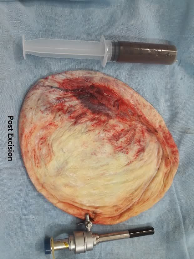 Giant 25×20 cm Ovarian Cyst Successfully Removed Laparoscopically