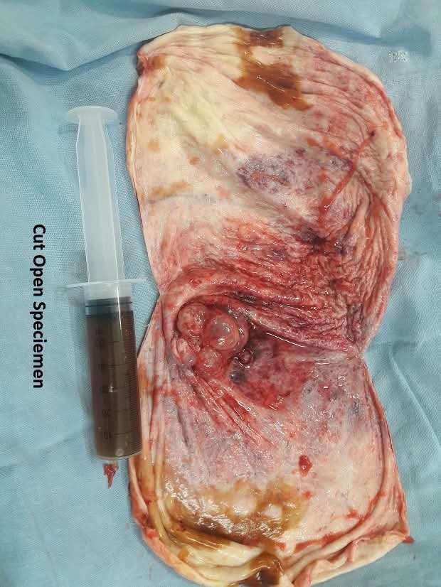 Cut open specimen — mucinous cystadenoma