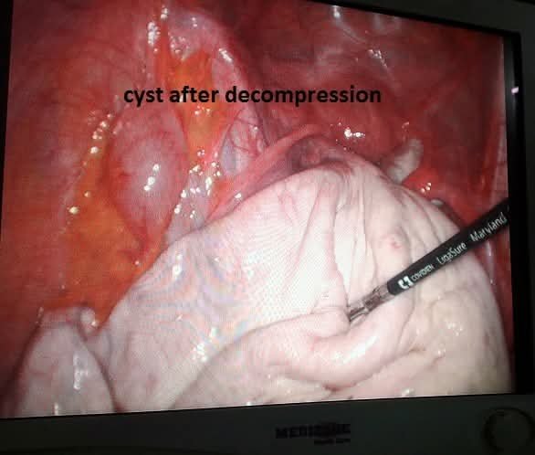 Cyst after decompression