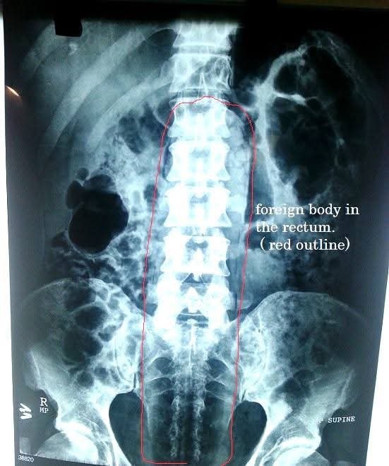 Successful Transanal Removal of Large Rectal Foreign Bodies Without Laparotomy