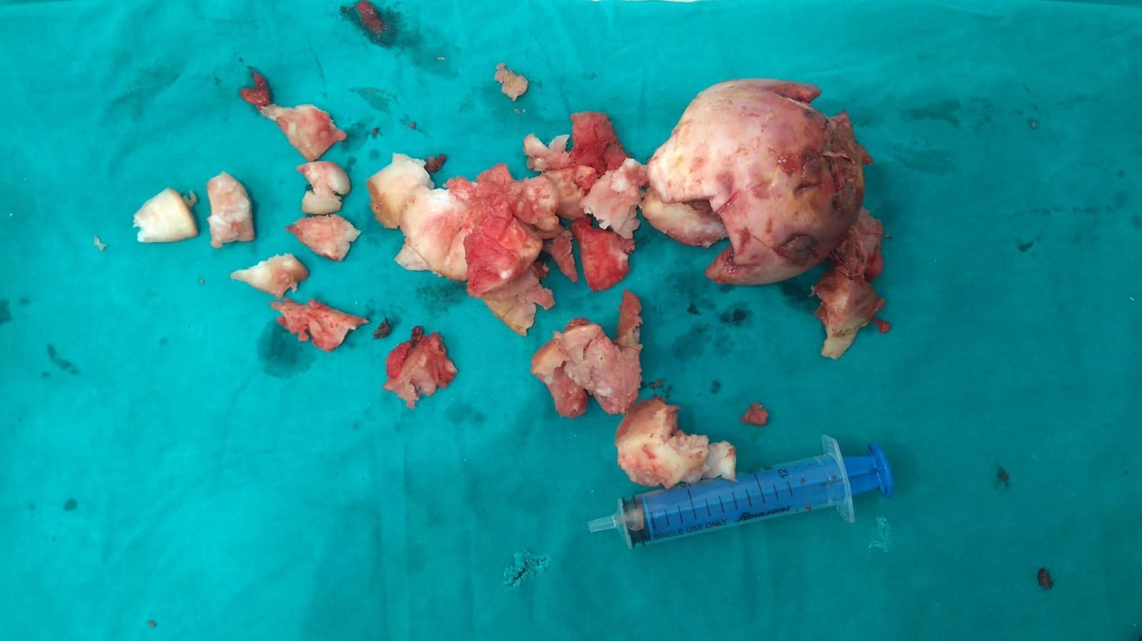 Piecemeal material removed during transanal extraction