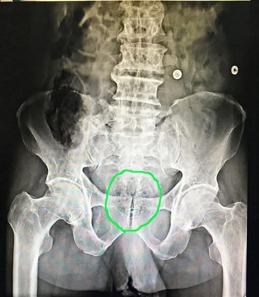 X-ray showing a retained rectal foreign body in the pelvis