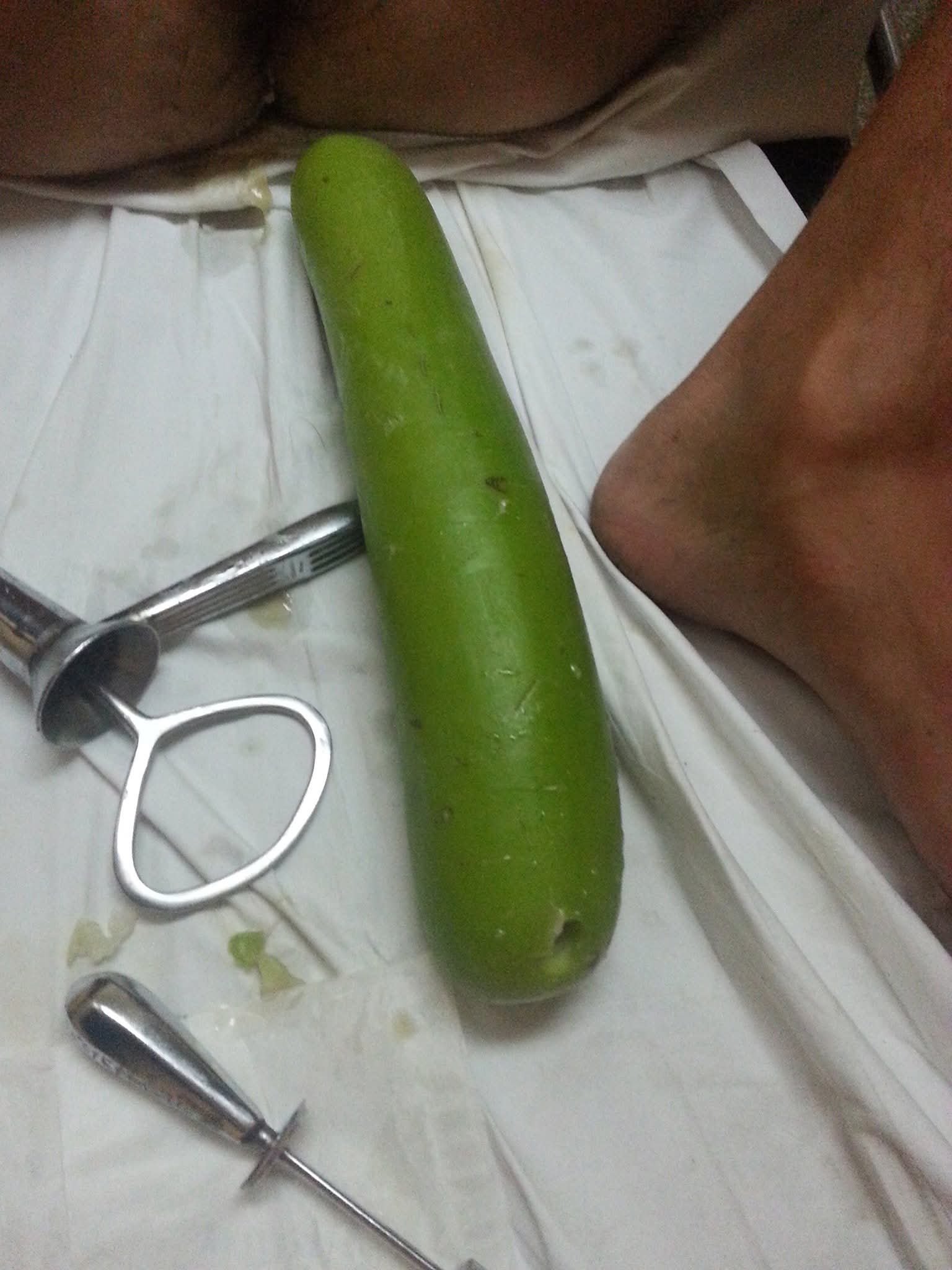Bottle gourd removed during rectal foreign-body treatment