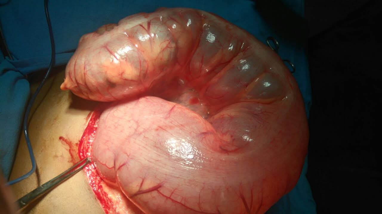 Emergency Surgery for Sigmoid Volvulus with Acute Large Bowel Obstruction