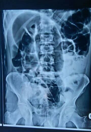 Abdominal X-ray showing Coffee Bean Sign of sigmoid volvulus