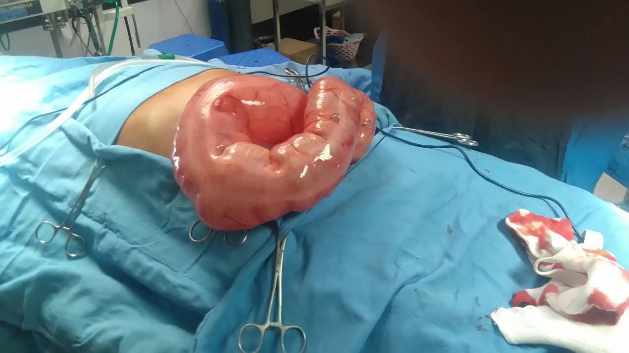 Untwisted sigmoid colon during volvulus surgery