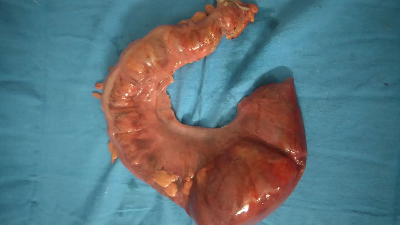 Resected sigmoid colon specimen