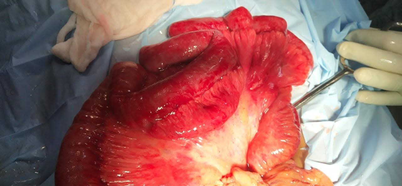 Near-Gangrenous Small Bowel Successfully Salvaged Without Resection