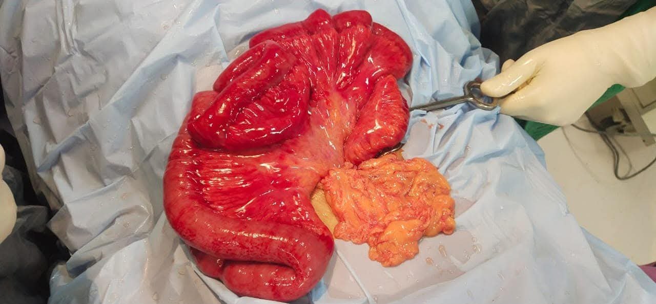Ischemic jejunal segment during emergency exploratory surgery
