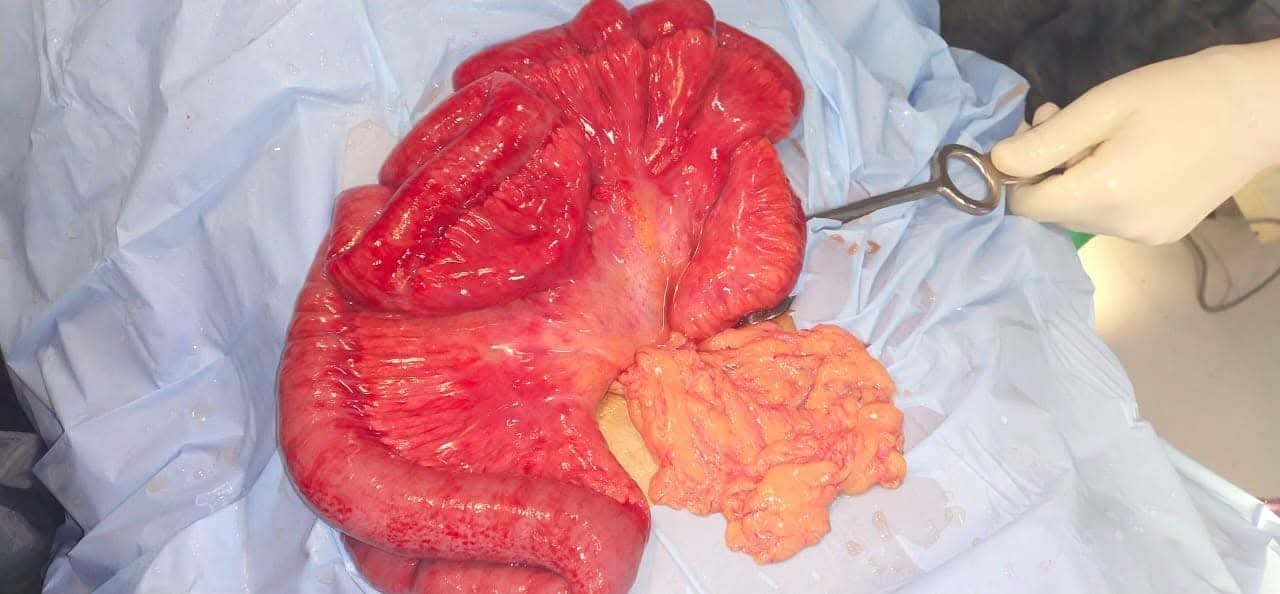Salvaged small bowel after restoration of blood supply