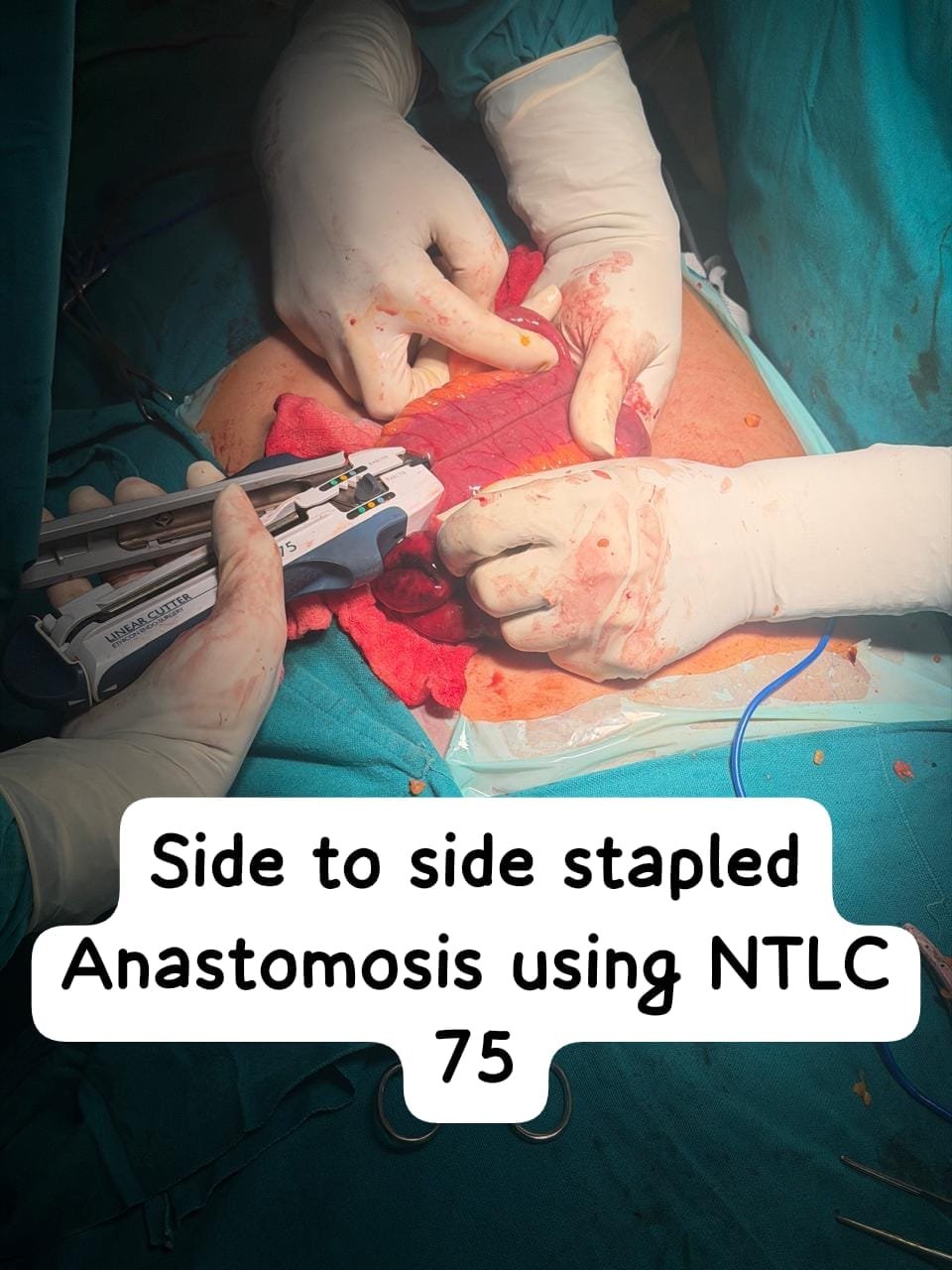 Stapled functional end-to-end ileo-ileal anastomosis