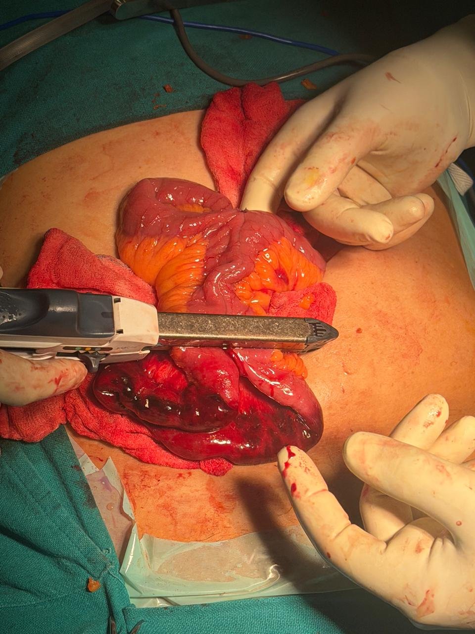 Intraoperative view of strangulated bowel during hernia surgery