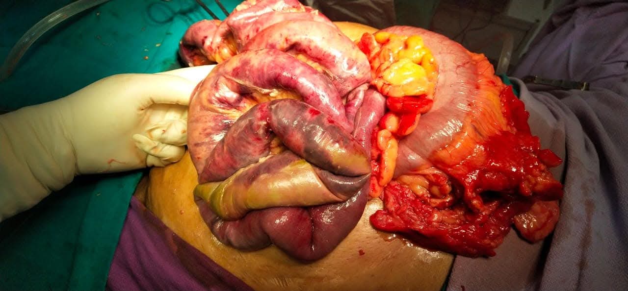 Near-Total Small Bowel Gangrene Successfully Managed by Dr. Raman Garg: An Extraordinary Recovery Against the Odds