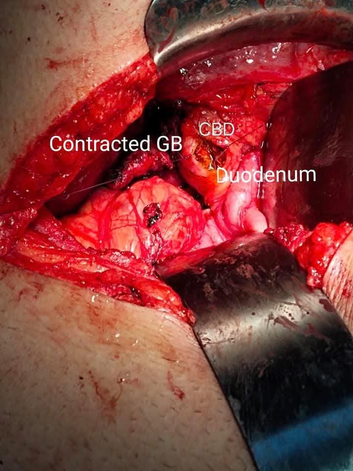 Failed ERCP Successfully Managed with Open CBD Exploration and Intraoperative Choledochoscopy by Dr. Raman Garg