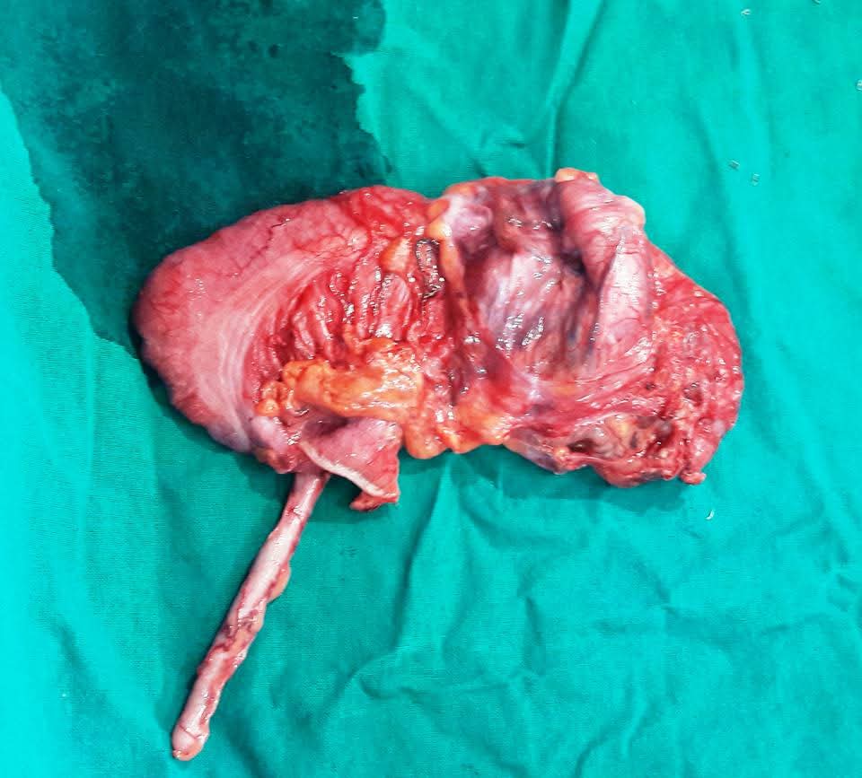 Rare Adult Colocolic Intussusception Caused by Colon Cancer Successfully Managed in an 88-Year-Old Patient