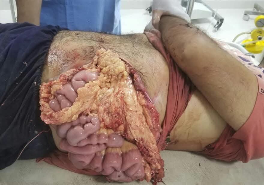 Devastating Abdominal Crush Injury with Complete Bowel Evisceration Successfully Reconstructed by Dr. Raman Garg