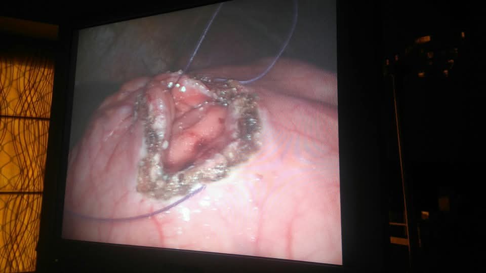 Laparoscopic Cystogastrostomy for Giant Pancreatic Pseudocyst