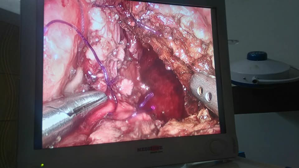 Laparoscopic dissection during cystogastrostomy for pancreatic pseudocyst