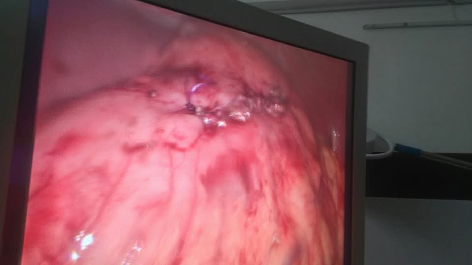 Internal view of the pancreatic pseudocyst cavity during laparoscopic drainage