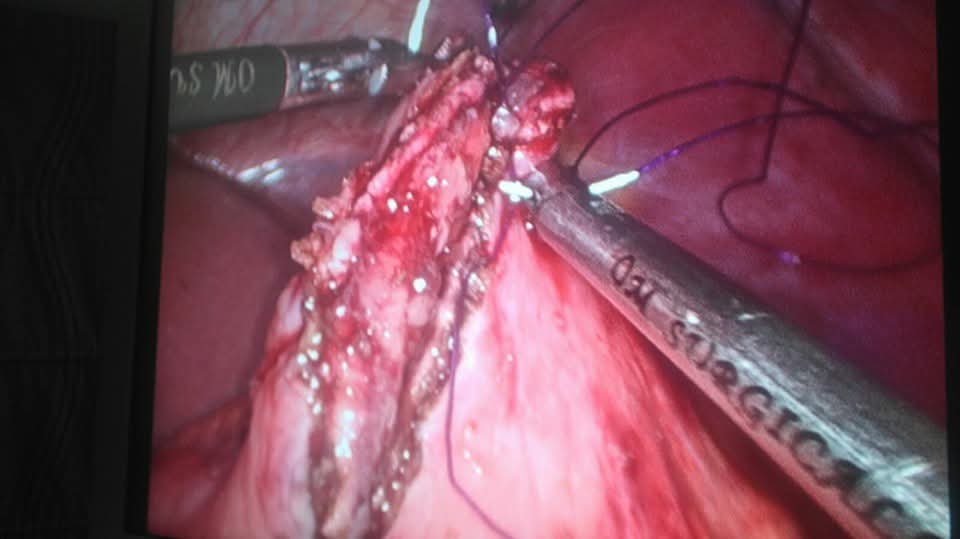 Laparoscopic suturing of the cystogastrostomy opening