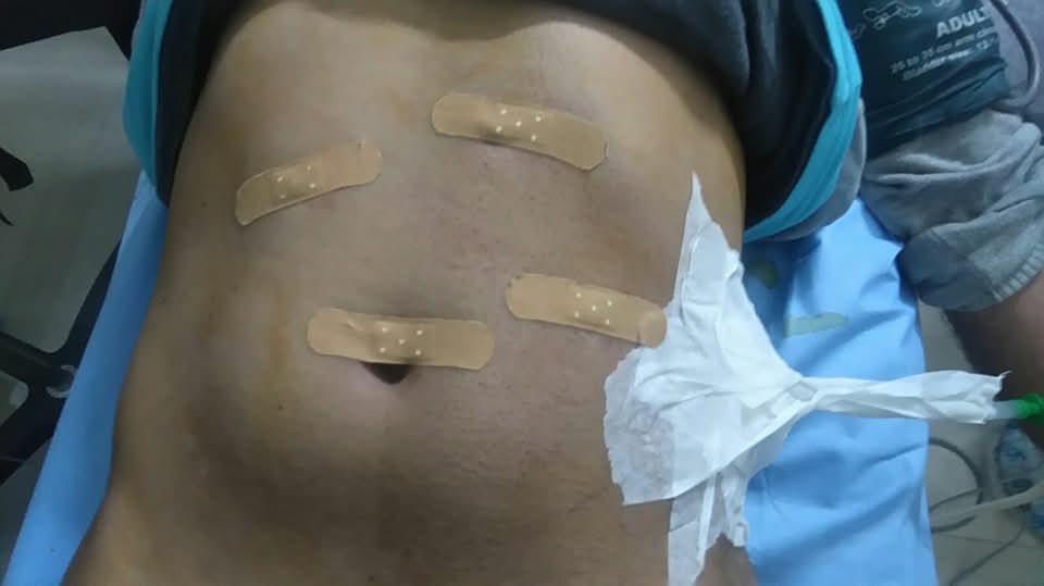 Small laparoscopic port site incisions after cystogastrostomy surgery