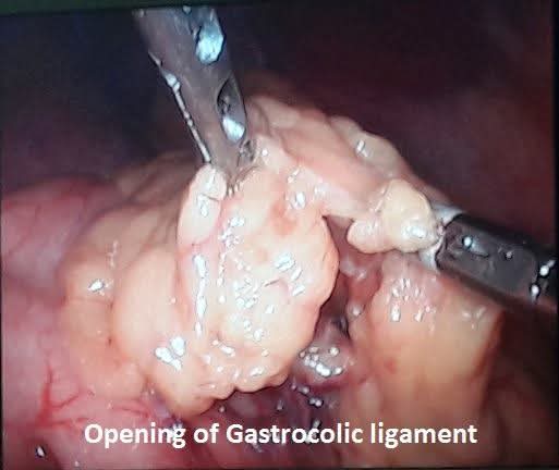 Laparoscopic opening of the gastrocolic ligament to access the pancreas