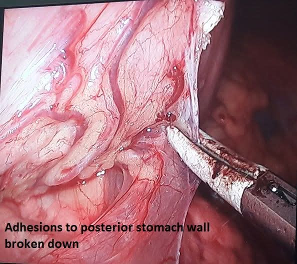 Laparoscopic release of adhesions to the posterior stomach wall