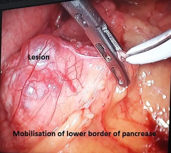 Mobilisation of the lower border of the pancreas showing the cystic lesion