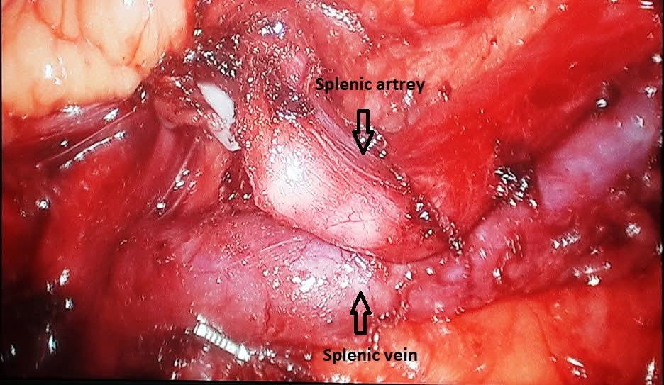Laparoscopic Distal Pancreatectomy with Splenic Preservation