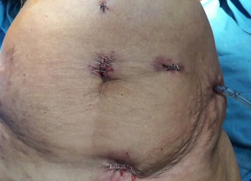 Small laparoscopic port site incisions after distal pancreatectomy surgery
