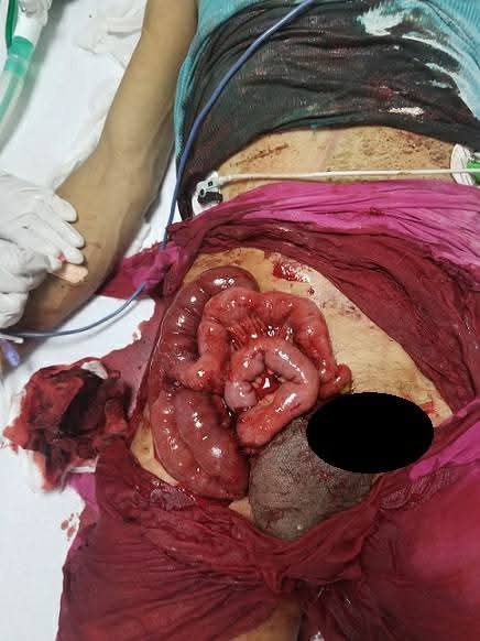 Life-Saving Emergency Surgery After High-Voltage Electrical Injury with Complete Jejunal Transection Successfully Performed by Dr. Raman Garg