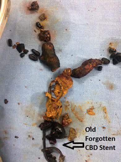 Forgotten CBD Stent Leading to Giant Bile Duct Stone Formation: A Preventable Complication