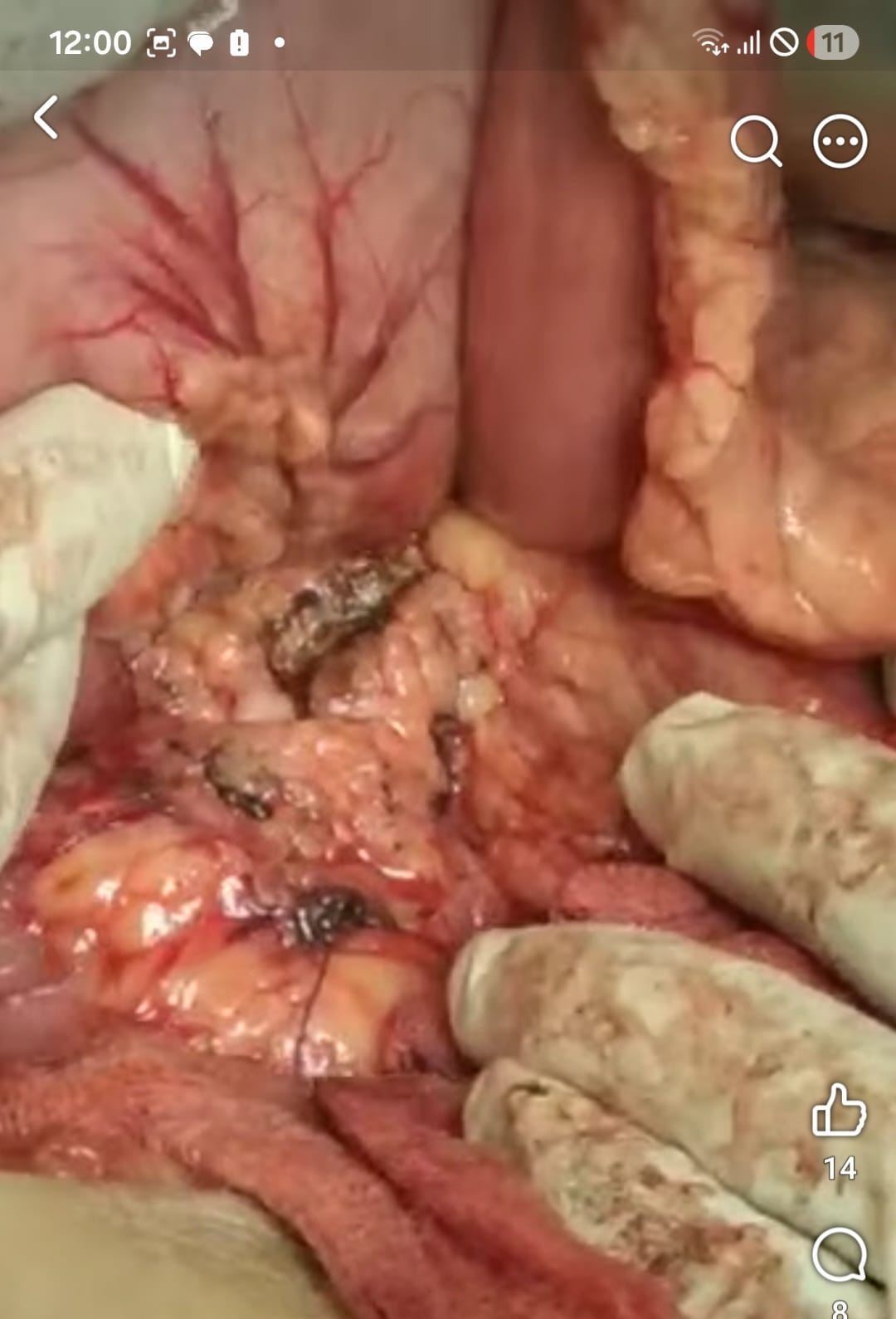 Frey's Procedure for Chronic Calcific Pancreatitis: Relief from Years of Debilitating Pain